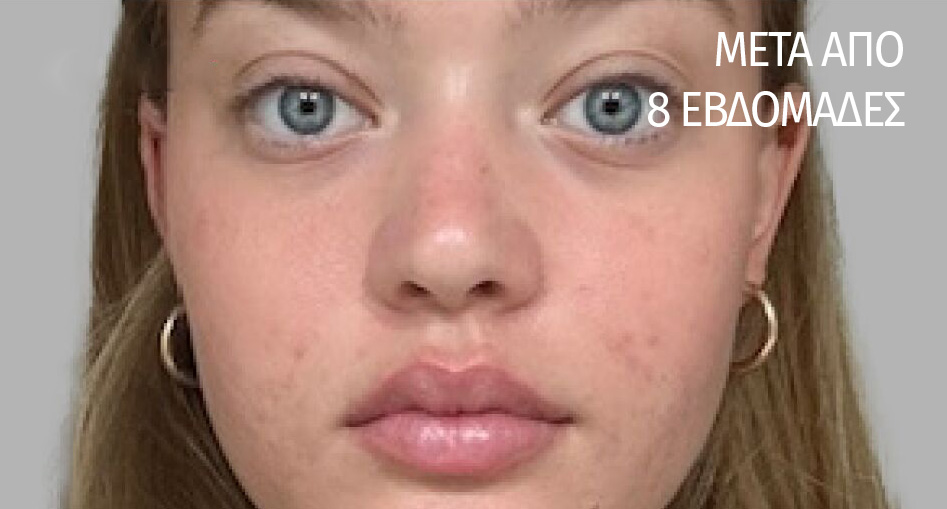 Biome-Balancing Acne / Blemish Treatment Serum. after image