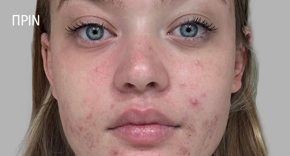 Biome-Balancing Acne / Blemish Treatment Serum. before image