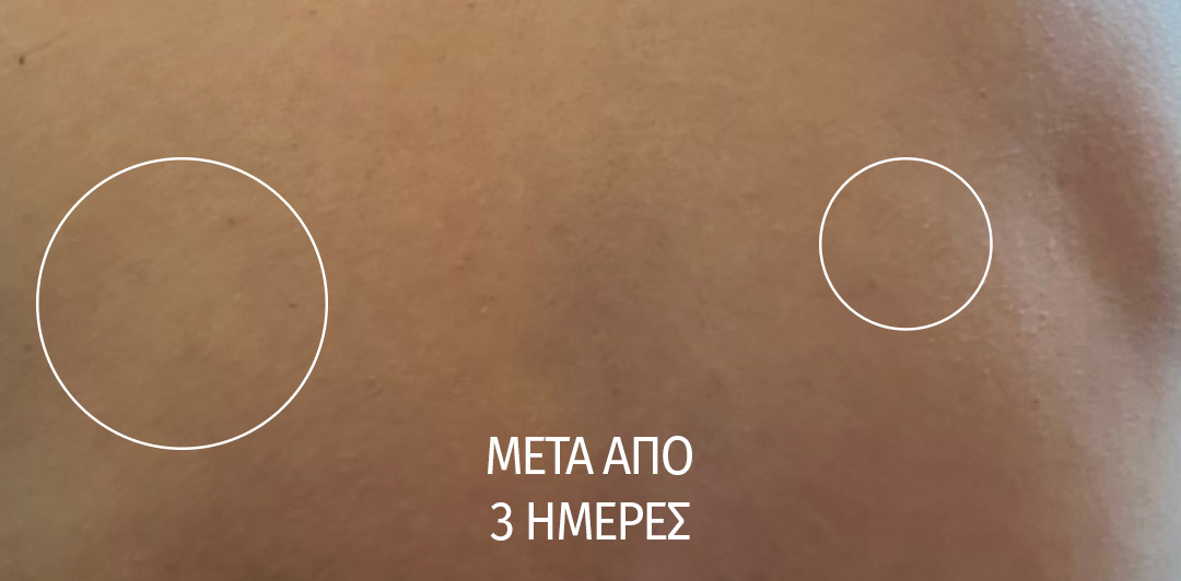 Retexturizing Body and Face Pads. Results after 3 days.
