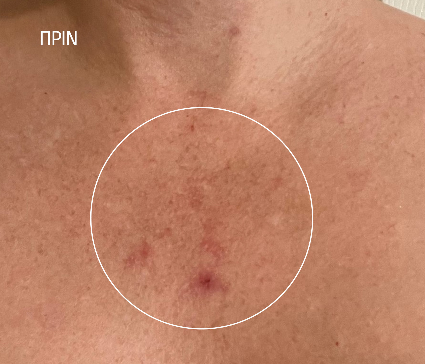 Retexturizing Body and Face Pads. Results before.